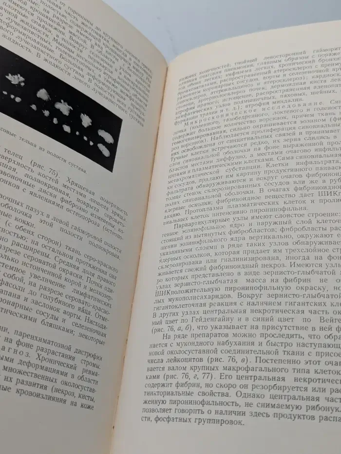 Патологическая анатомия и патогенез коллагеновых болезней