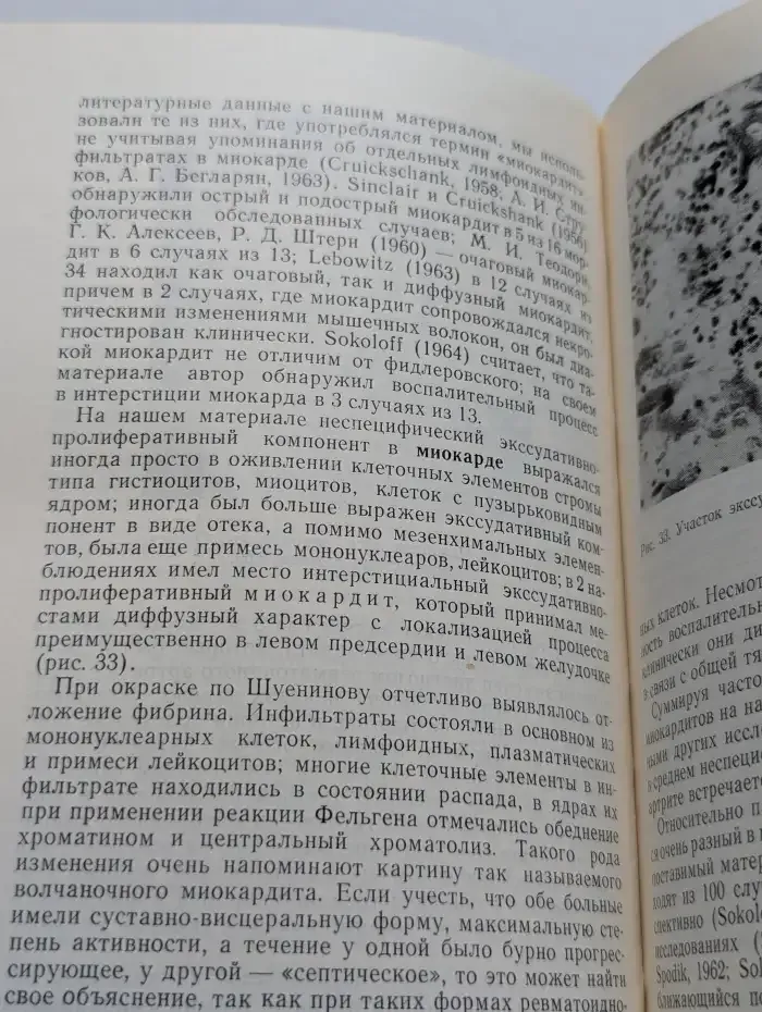 Поражения сердца при коллагеновых заболеваниях
